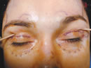 Browlift before photo