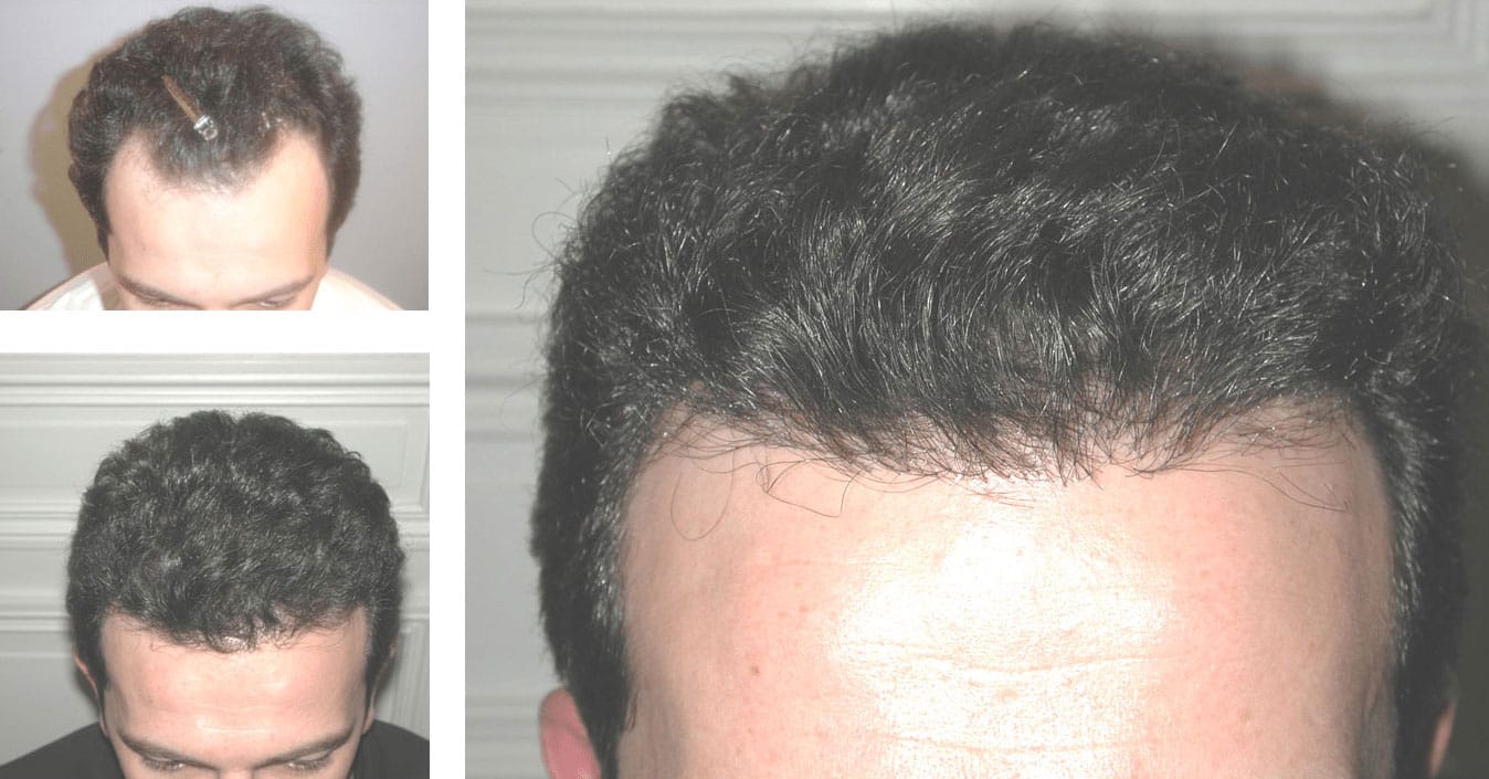 NeoGraft Hair Restoration Beverly Hills