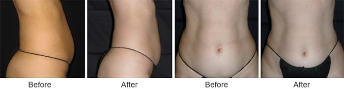 woman that received velashape