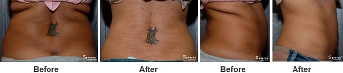 woman that received velashape